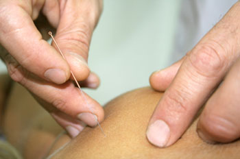 Indianapolis Acupuncture Treatment